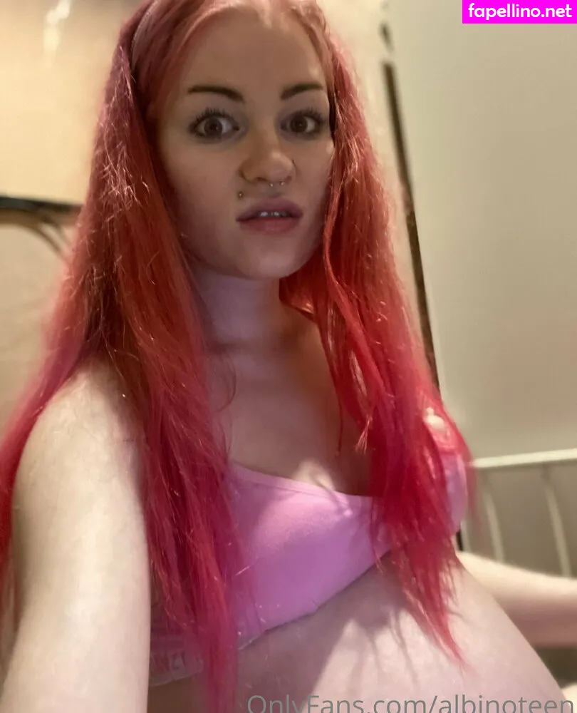 Albinoteen Leaked Nude Picture #GdCYCPyq8e